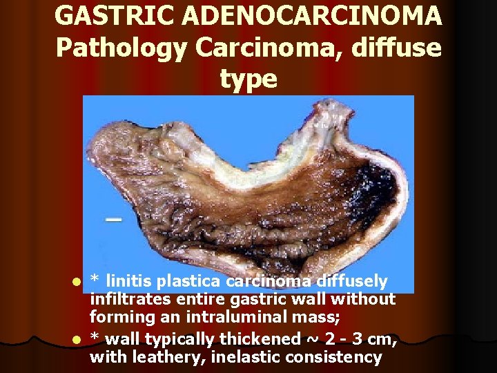 GASTRIC ADENOCARCINOMA Pathology Carcinoma, diffuse type * linitis plastica carcinoma diffusely infiltrates entire gastric