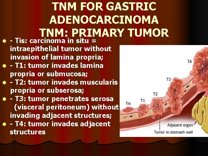 l l l TNM FOR GASTRIC ADENOCARCINOMA TNM: PRIMARY TUMOR - Tis: carcinoma in