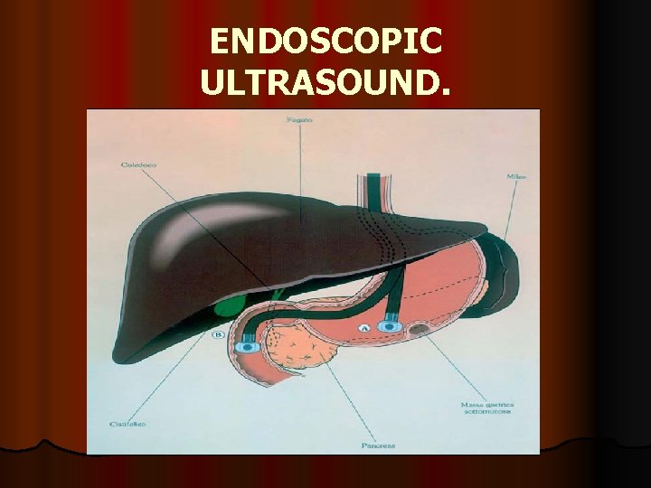 ENDOSCOPIC ULTRASOUND. 