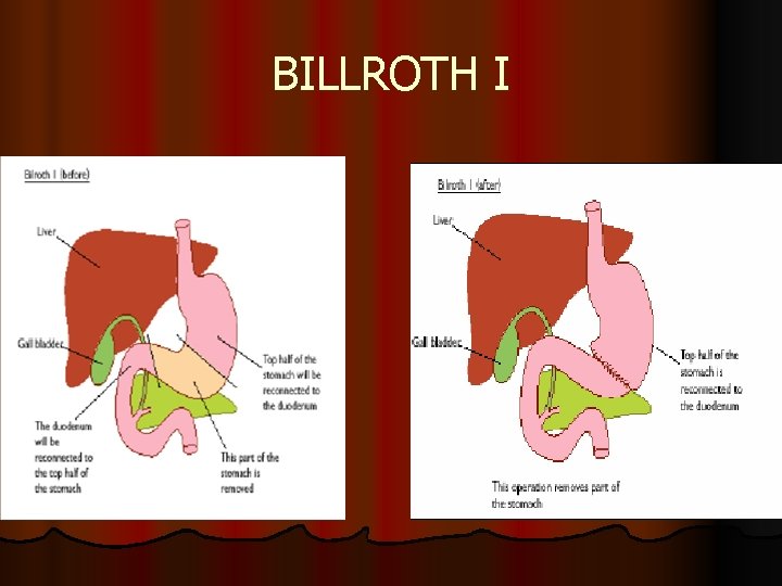 BILLROTH I 