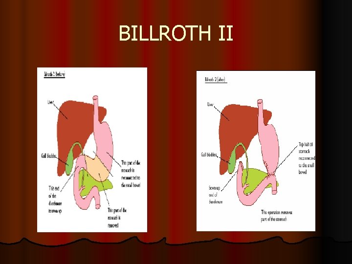 BILLROTH II 