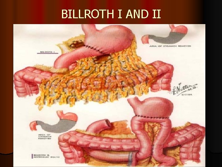 BILLROTH I AND II 