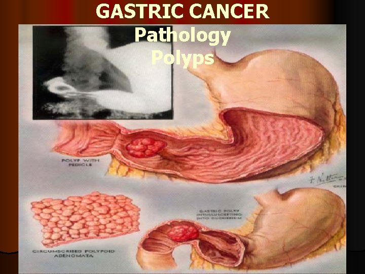 GASTRIC CANCER Pathology Polyps 