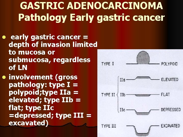 GASTRIC ADENOCARCINOMA Pathology Early gastric cancer early gastric cancer = depth of invasion limited