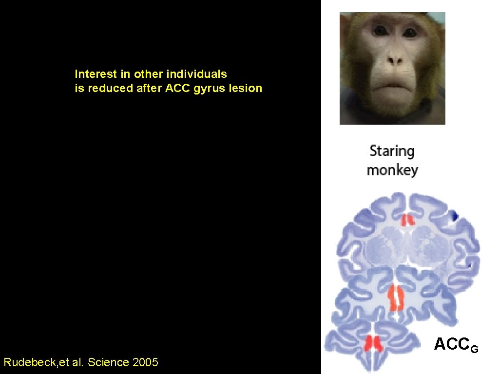 Interest in other individuals is reduced after ACC gyrus lesion ACCG Rudebeck, et al.