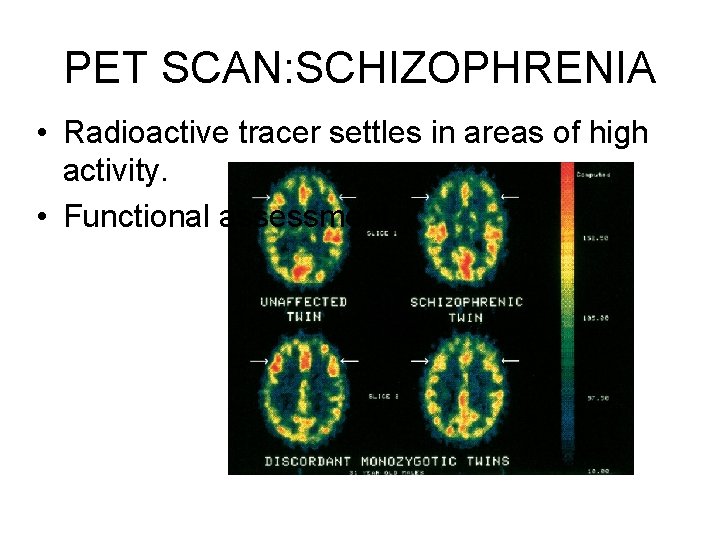 PET SCAN: SCHIZOPHRENIA • Radioactive tracer settles in areas of high activity. • Functional