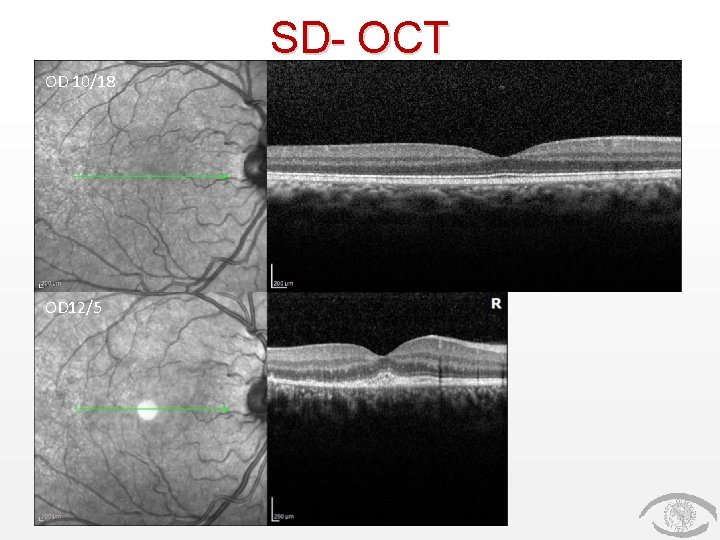 SD- OCT OD 10/18 OD 12/5 