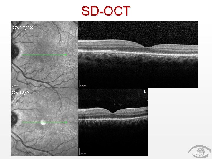 SD-OCT OS 10/18 OS 12/5 