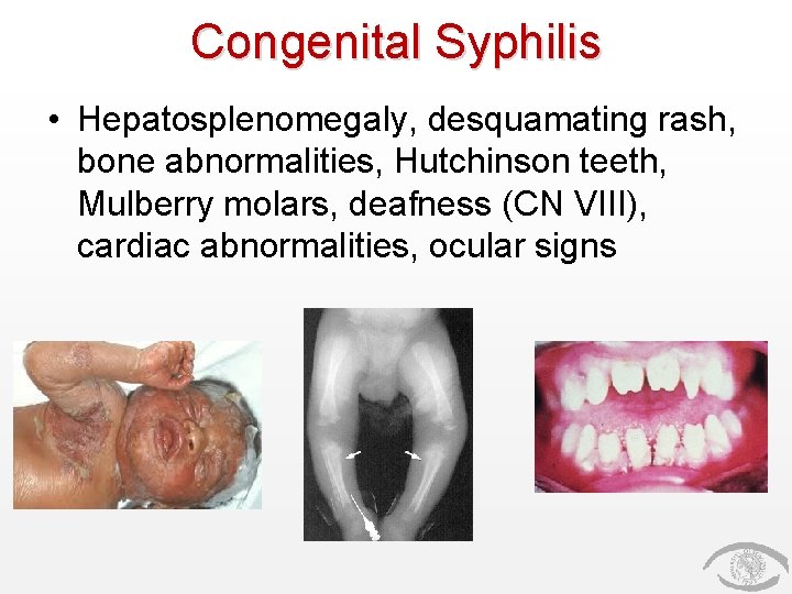 Congenital Syphilis • Hepatosplenomegaly, desquamating rash, bone abnormalities, Hutchinson teeth, Mulberry molars, deafness (CN