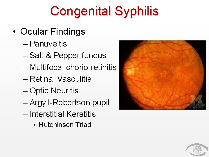 Congenital Syphilis • Ocular Findings – Panuveitis – Salt & Pepper fundus – Multifocal