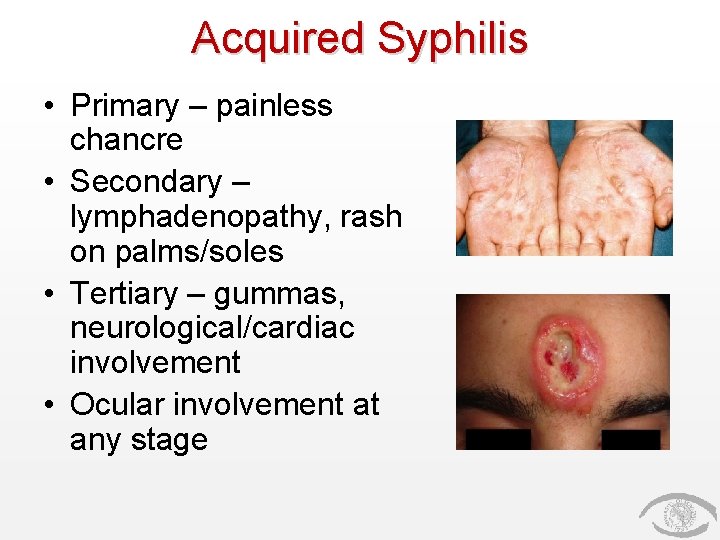 Acquired Syphilis • Primary – painless chancre • Secondary – lymphadenopathy, rash on palms/soles