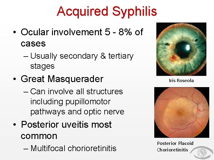 Acquired Syphilis • Ocular involvement 5 - 8% of cases – Usually secondary &