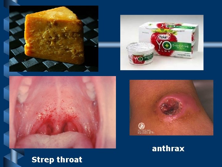 anthrax Strep throat 