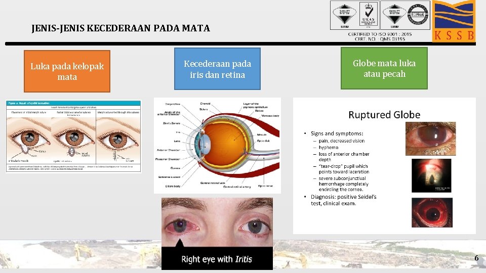 JENIS-JENIS KECEDERAAN PADA MATA Luka pada kelopak mata Kecederaan pada iris dan retina Globe