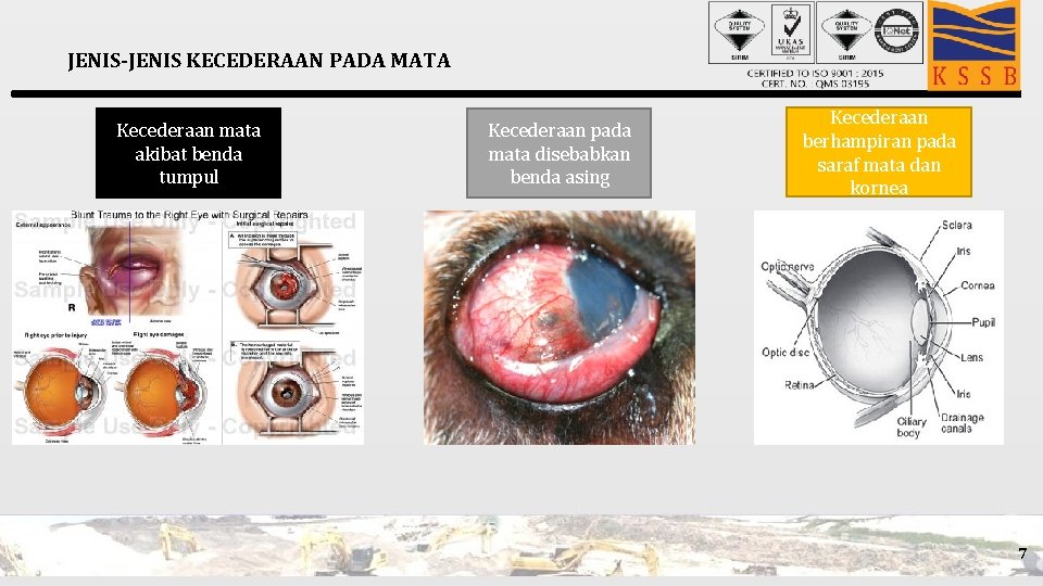 JENIS-JENIS KECEDERAAN PADA MATA Kecederaan mata akibat benda tumpul Kecederaan pada mata disebabkan benda