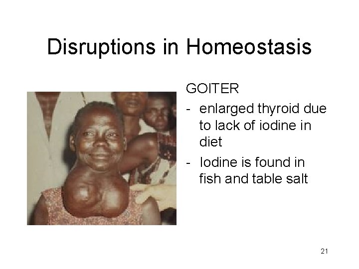 Disruptions in Homeostasis GOITER - enlarged thyroid due to lack of iodine in diet