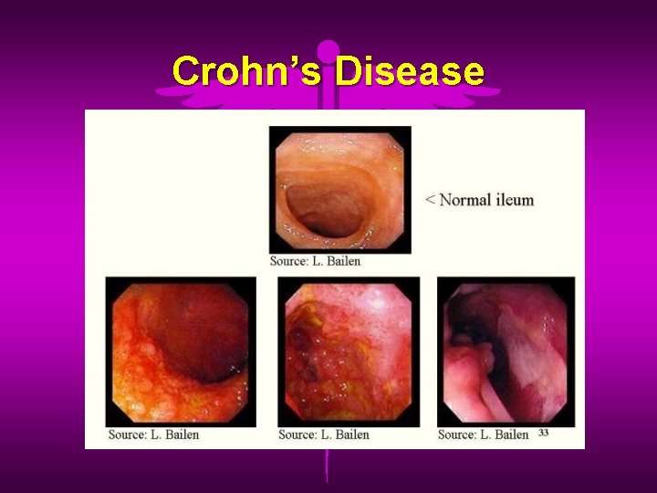 Crohn’s Disease 