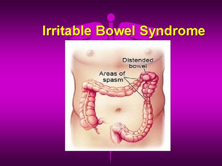 Irritable Bowel Syndrome 