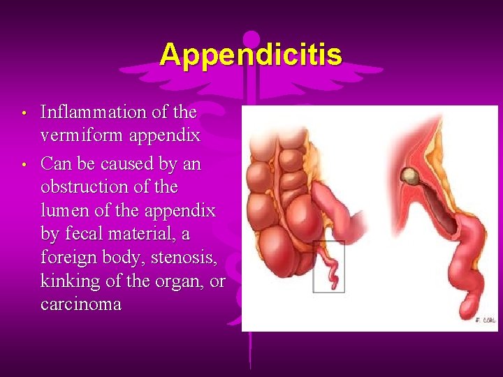 Appendicitis • • Inflammation of the vermiform appendix Can be caused by an obstruction