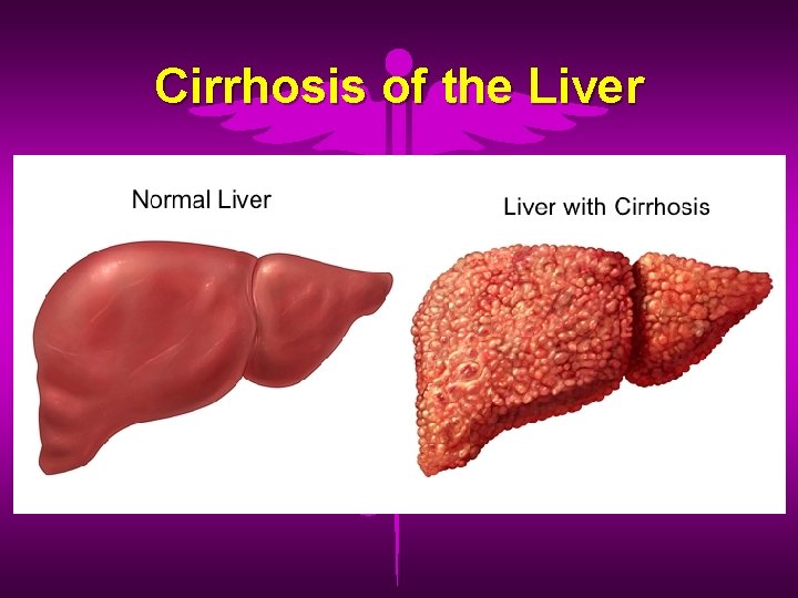 Cirrhosis of the Liver 