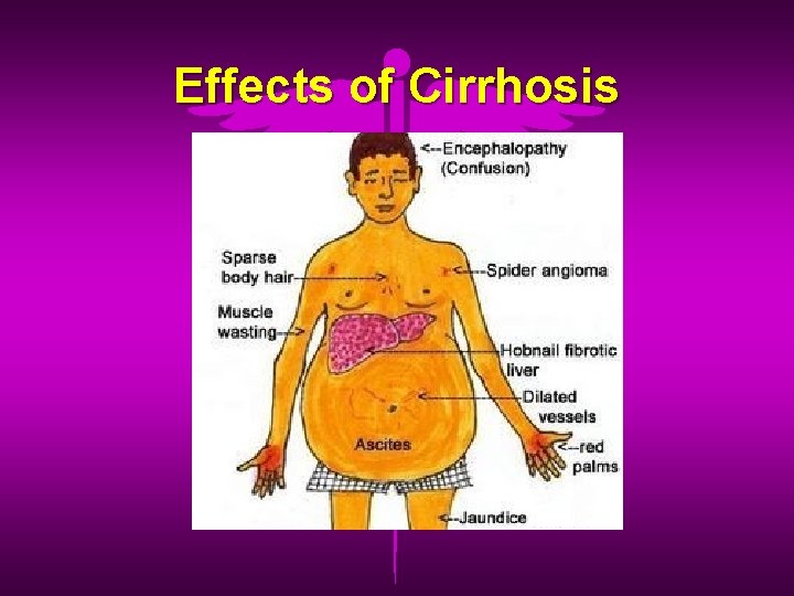 Effects of Cirrhosis 