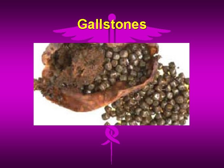 Gallstones 