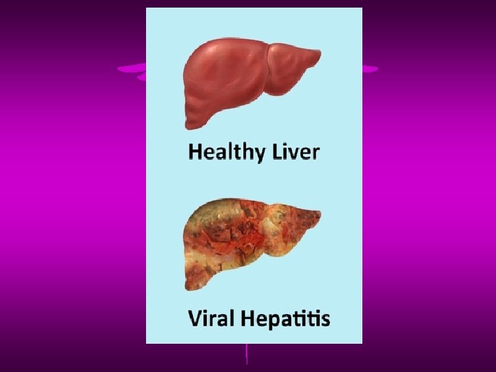 Hepatitis 