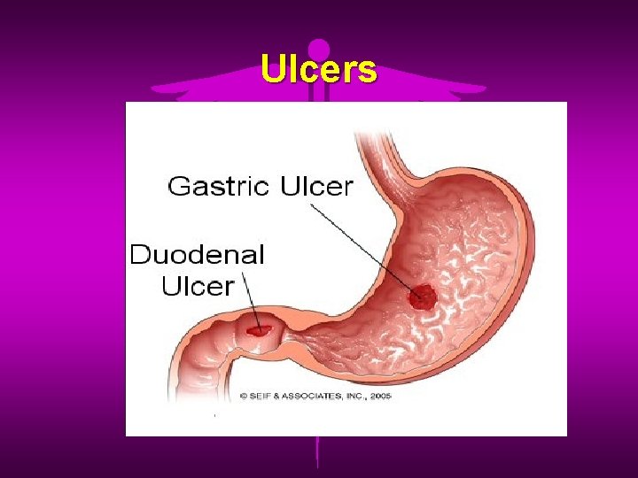 Ulcers 