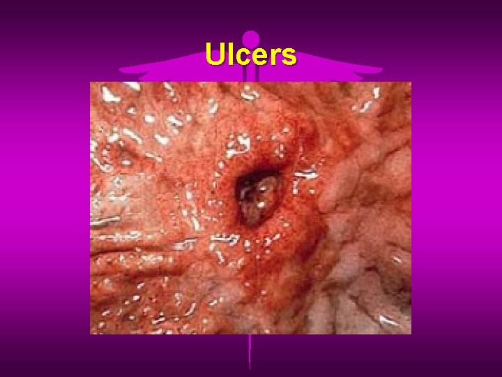 Ulcers 