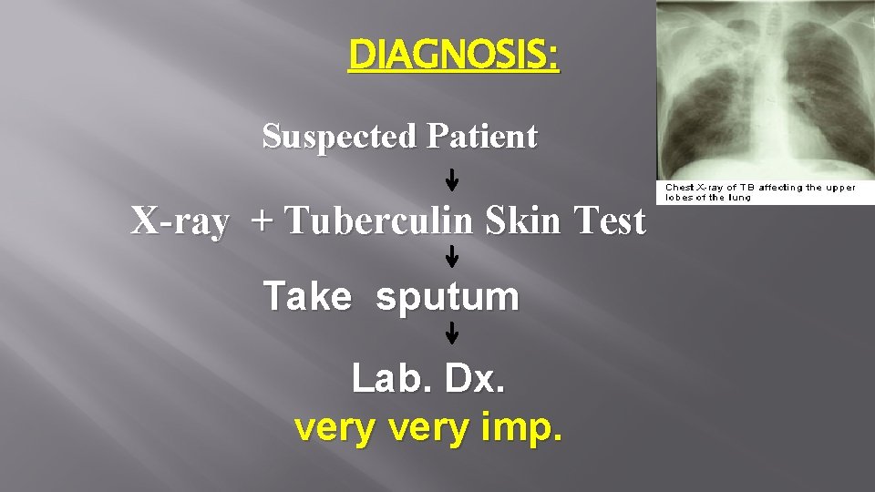 DIAGNOSIS: Suspected Patient X-ray + Tuberculin Skin Test Take sputum Lab. Dx. very imp.