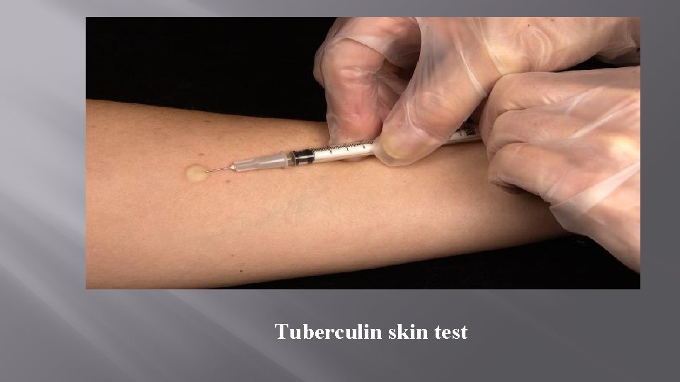 Tuberculin skin test 