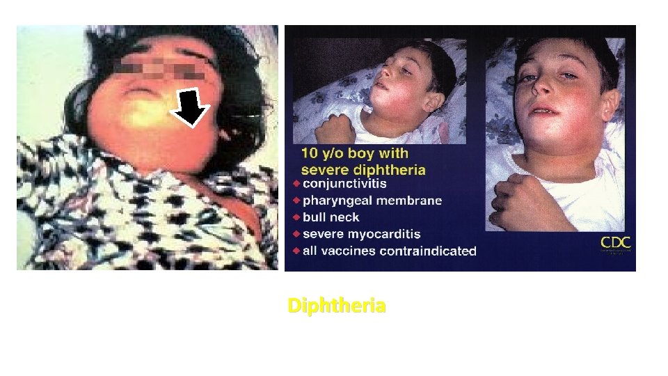 Diphtheria 