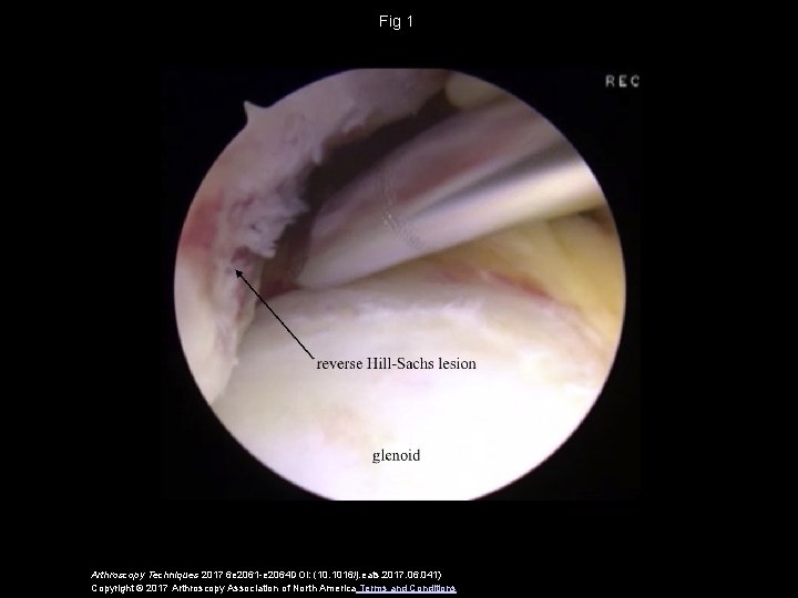 Fig 1 Arthroscopy Techniques 2017 6 e 2061 -e 2064 DOI: (10. 1016/j. eats.