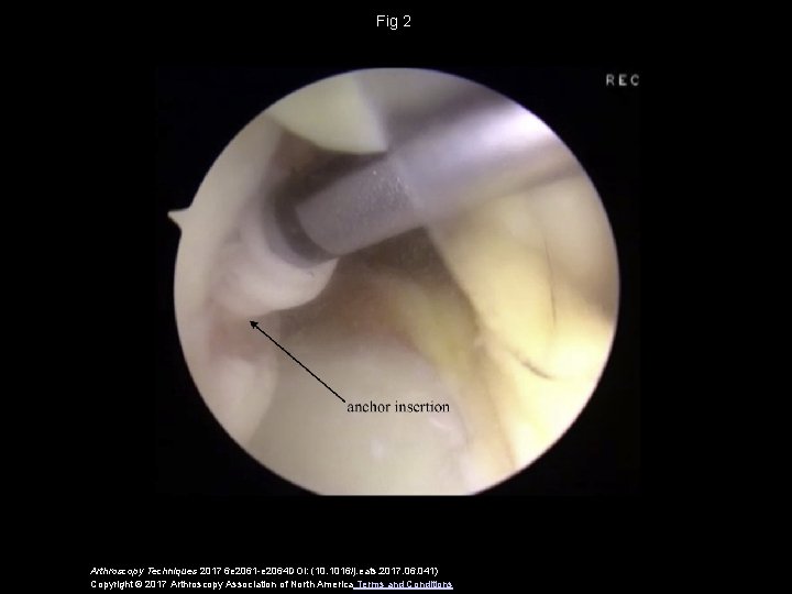 Fig 2 Arthroscopy Techniques 2017 6 e 2061 -e 2064 DOI: (10. 1016/j. eats.