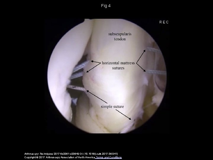 Fig 4 Arthroscopy Techniques 2017 6 e 2061 -e 2064 DOI: (10. 1016/j. eats.