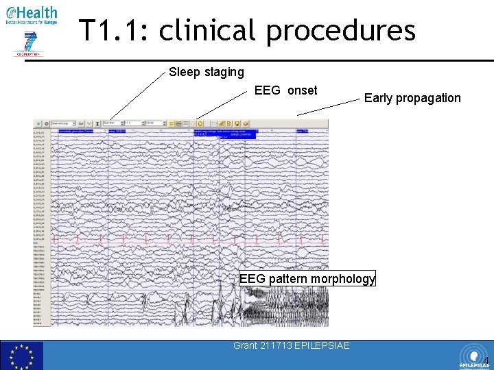 T 1. 1: clinical procedures Sleep staging EEG onset Early propagation EEG pattern morphology