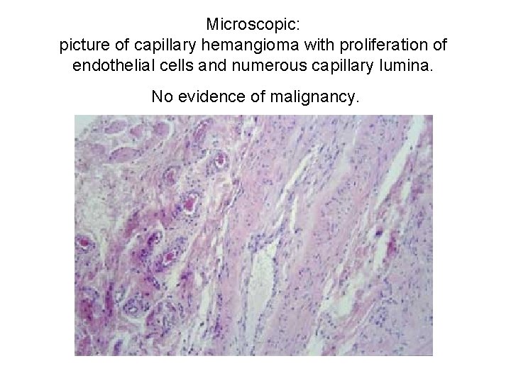 Microscopic: picture of capillary hemangioma with proliferation of endothelial cells and numerous capillary lumina.