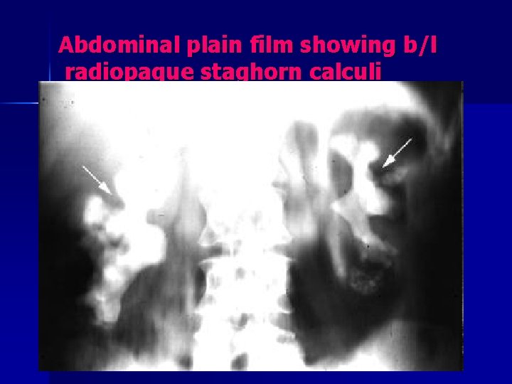 Abdominal plain film showing b/l radiopaque staghorn calculi 