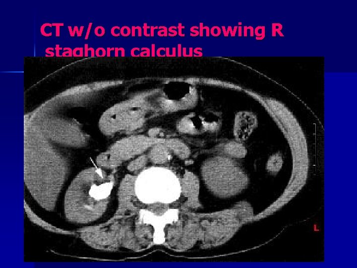 CT w/o contrast showing R staghorn calculus 