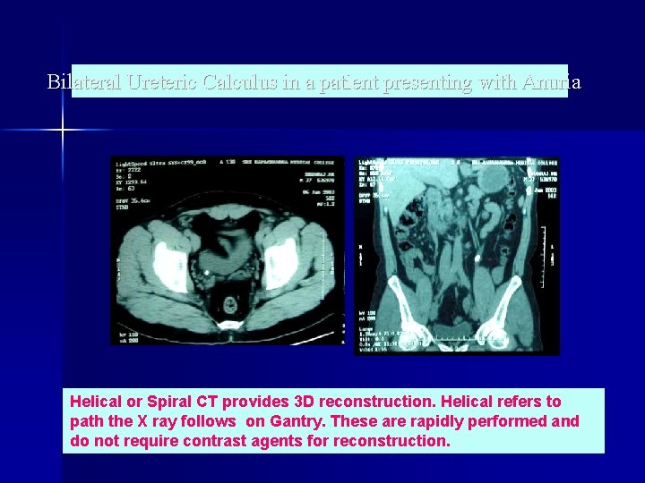 Bilateral Ureteric Calculus in a patient presenting with Anuria Helical or Spiral CT provides