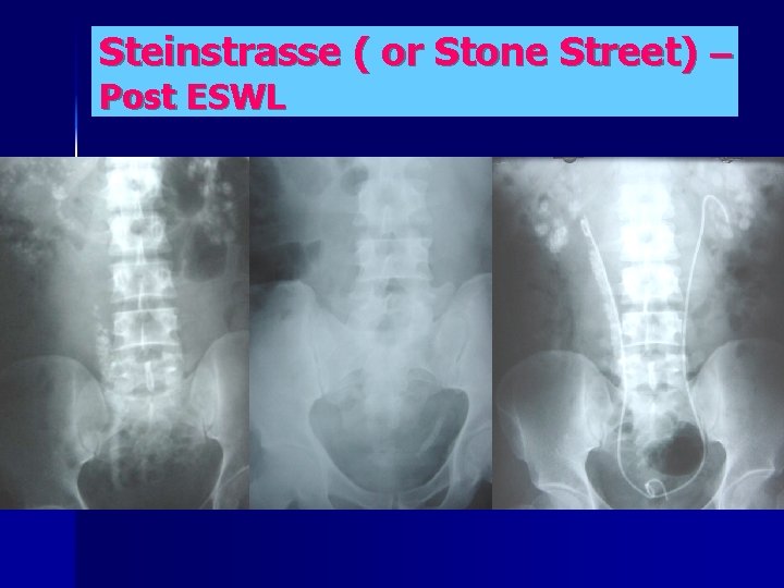 Steinstrasse ( or Stone Street) – Post ESWL 