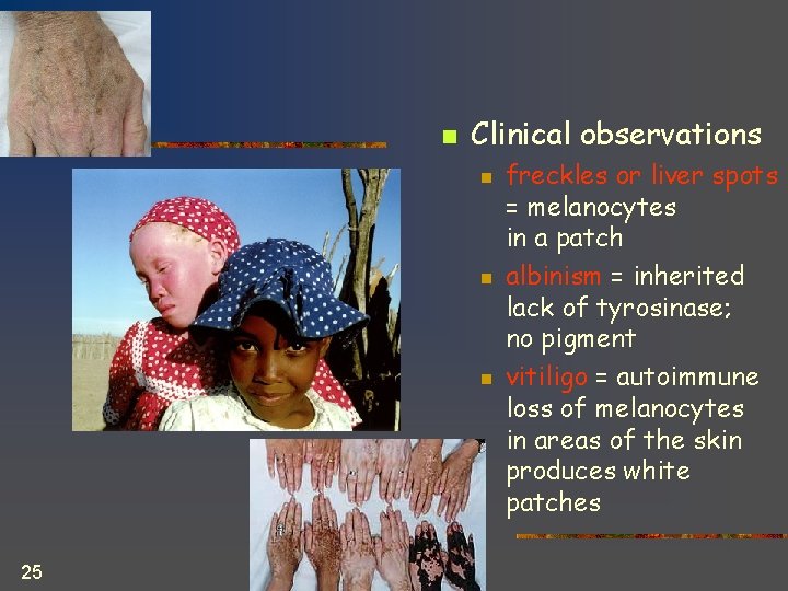 n Clinical observations n n n 25 freckles or liver spots = melanocytes in