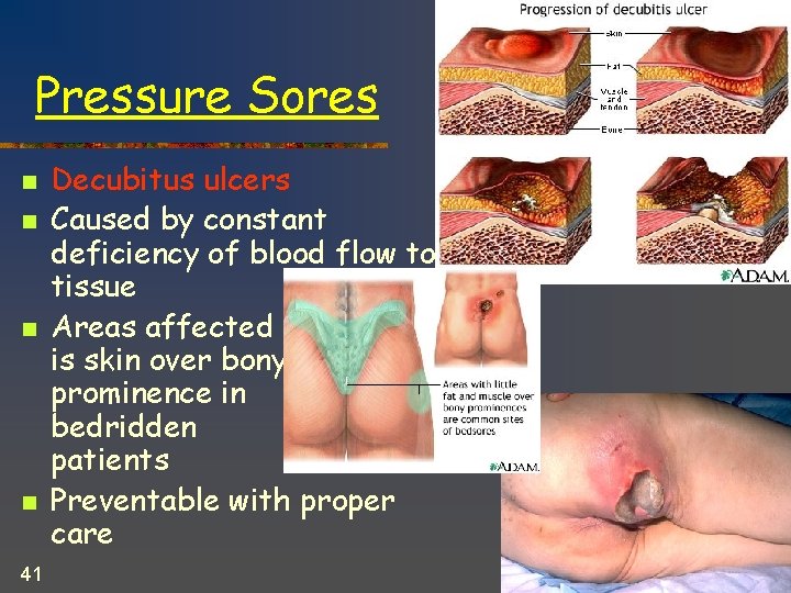 Pressure Sores n n 41 Decubitus ulcers Caused by constant deficiency of blood flow