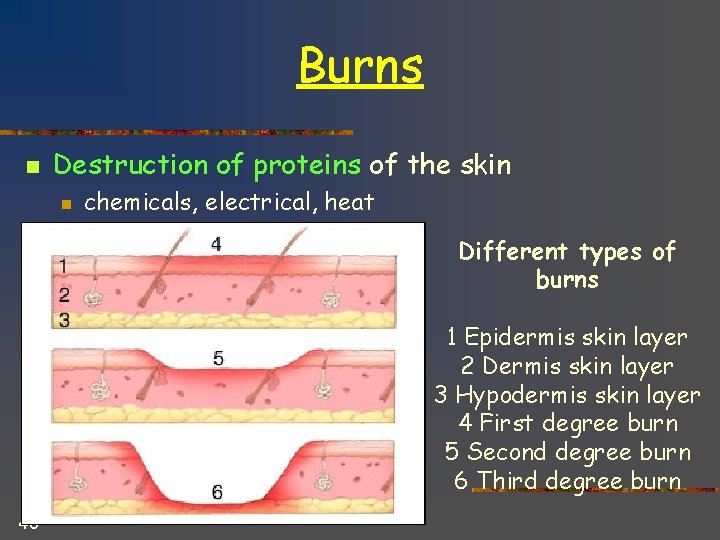 Burns n Destruction of proteins of the skin n chemicals, electrical, heat Different types