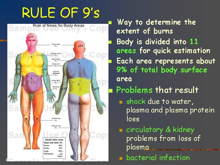 RULE OF 9’s n n Way to determine the extent of burns Body is