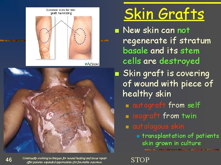 Skin Grafts n n autograft from self n isograft from twin n autologous skin