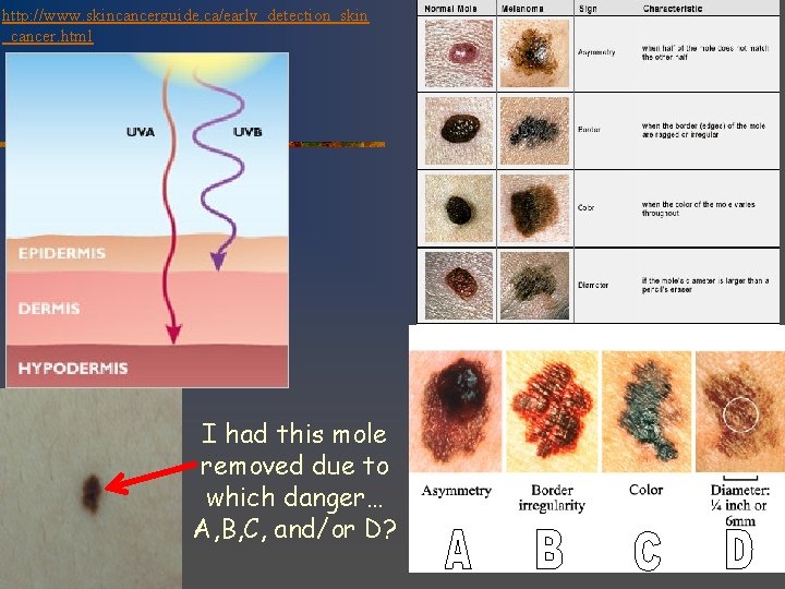 http: //www. skincancerguide. ca/early_detection_skin _cancer. html I had this mole removed due to which