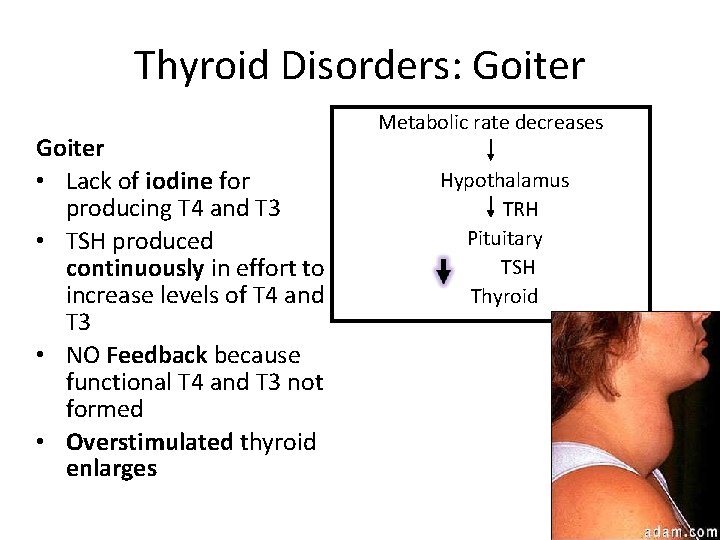 Thyroid Disorders: Goiter • Lack of iodine for producing T 4 and T 3