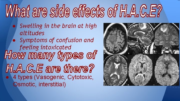 ● Swelling in the brain at high altitudes ● Symptoms of confusion and feeling