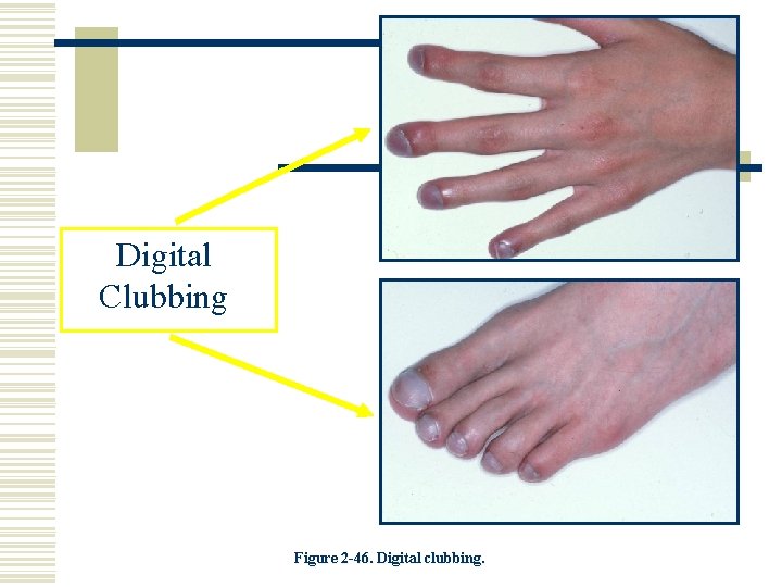 Digital Clubbing Figure 2 -46. Digital clubbing. 